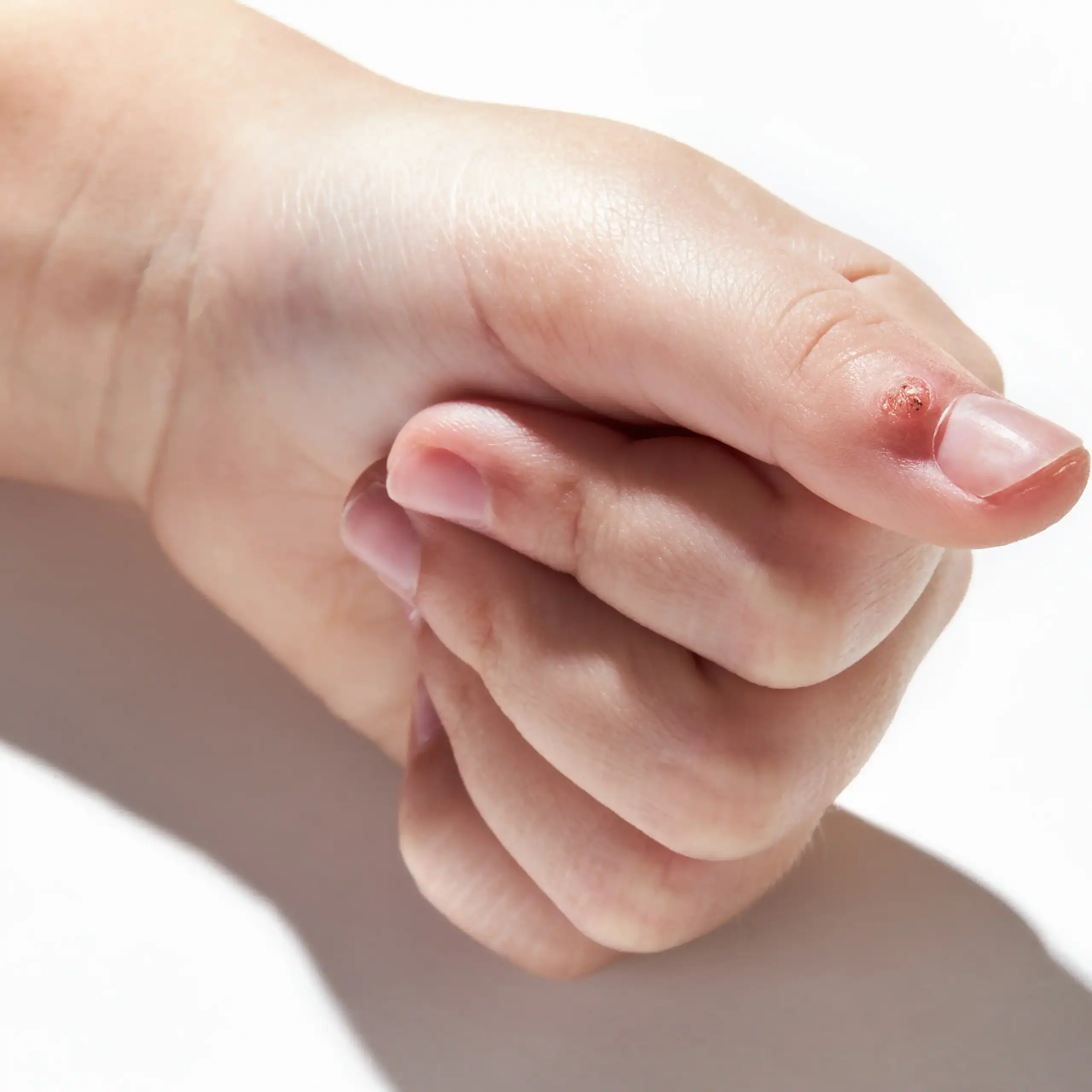 Wart on a young person's thumb