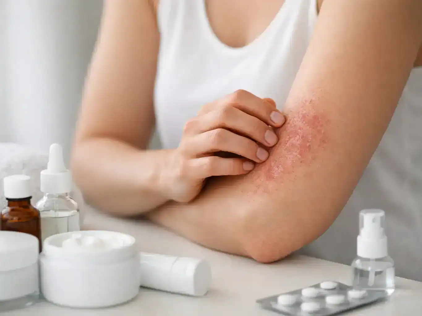 Best Treatment for Eczema Flare Ups