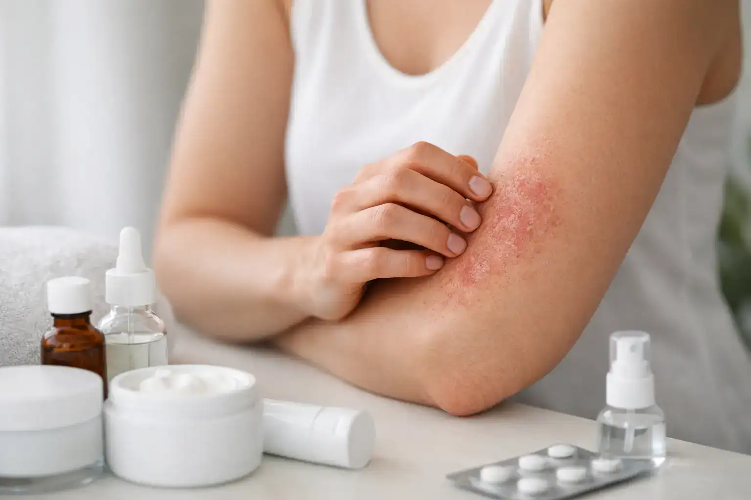 El mejor tratamiento para los brotes de eccema