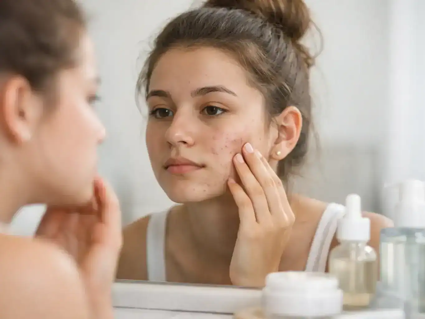 Teen Acne Scar Care That Actually Helps