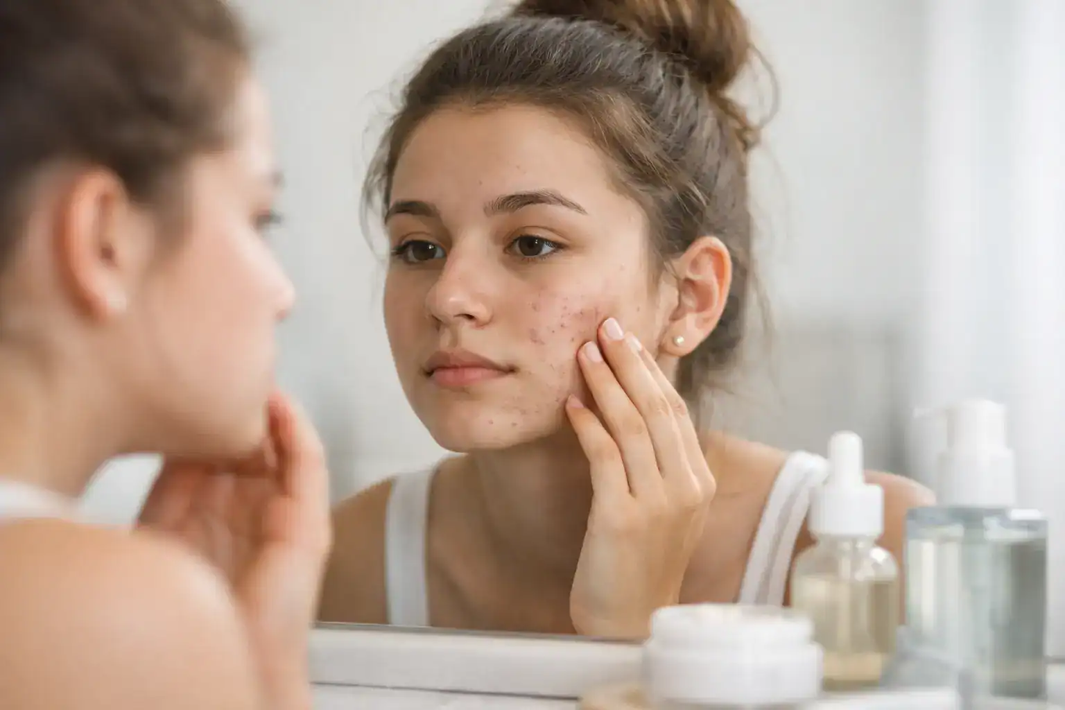 Teen Acne Scar Care That Actually Helps