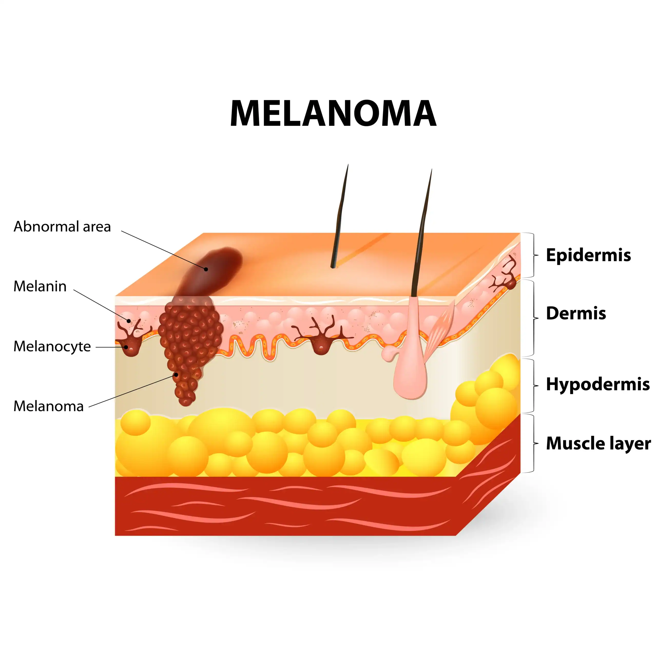 Graphic showing how melanoma, a rare cancer, grows in the skin