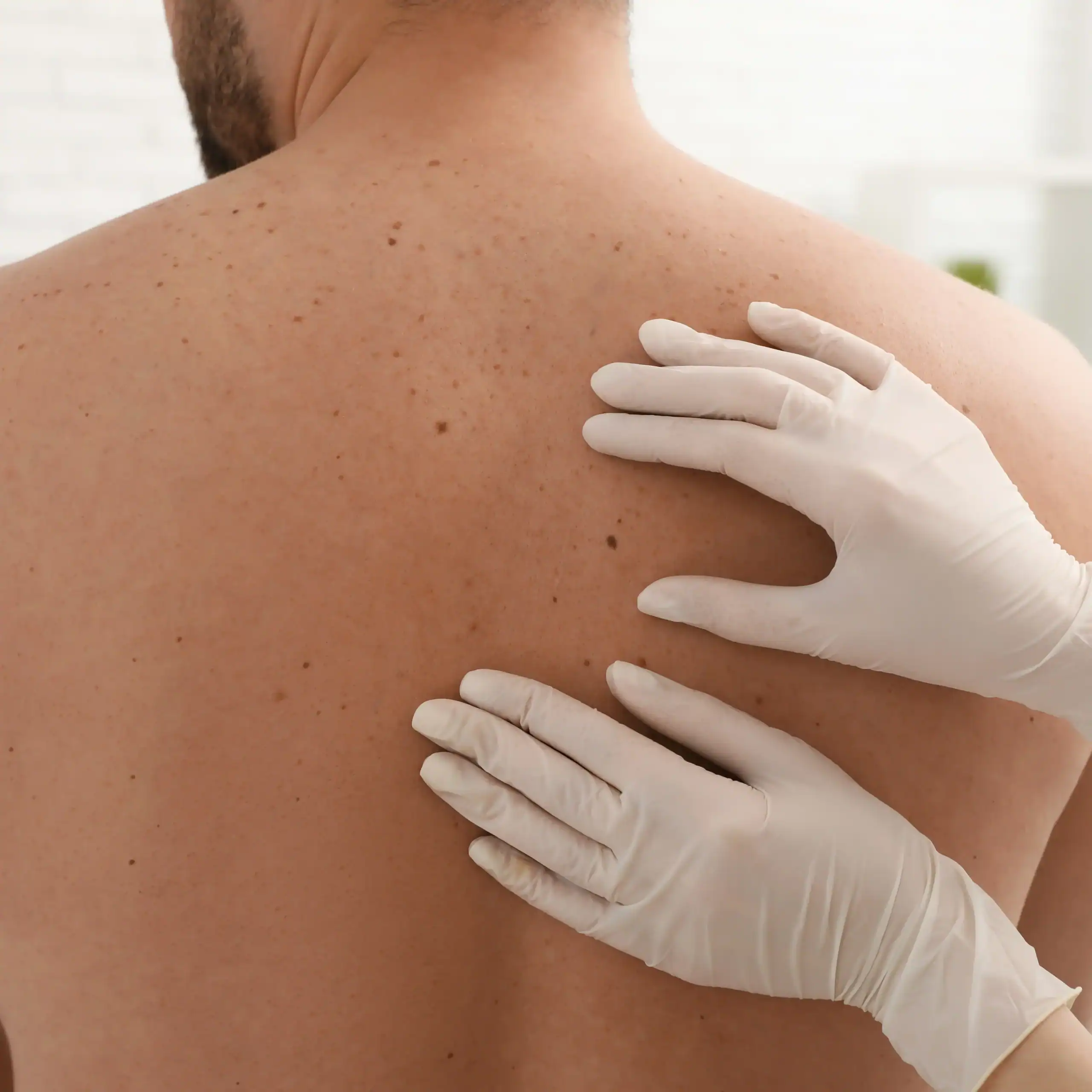 Man getting the skin on his back checked at the dermatologist