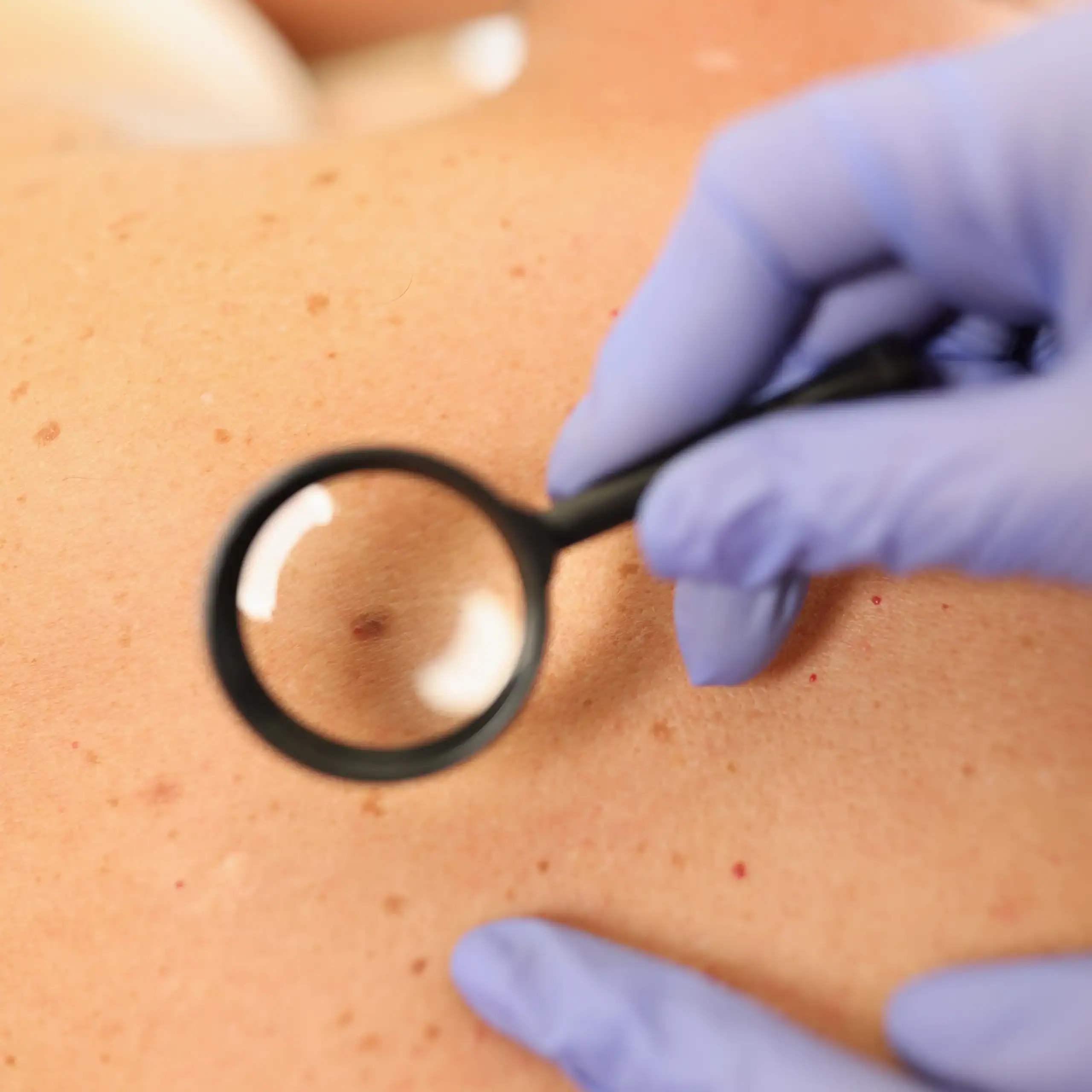 Dermatologist using magnification to look at a skin growth