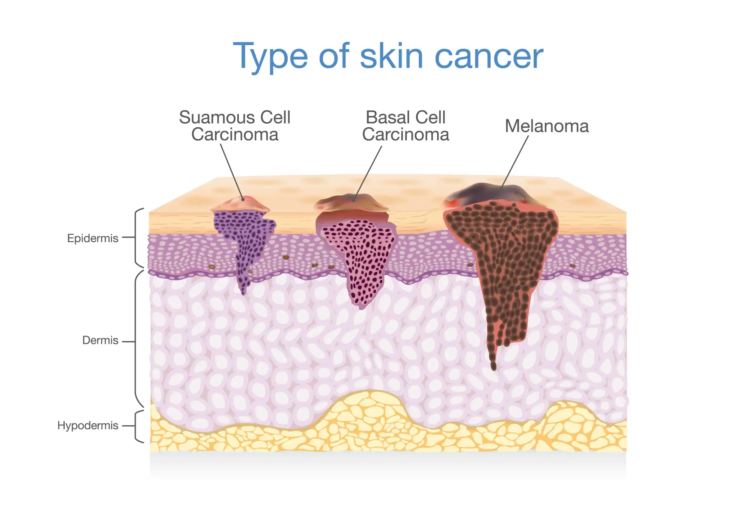 Infographic showing different types of skin cancer in the skin