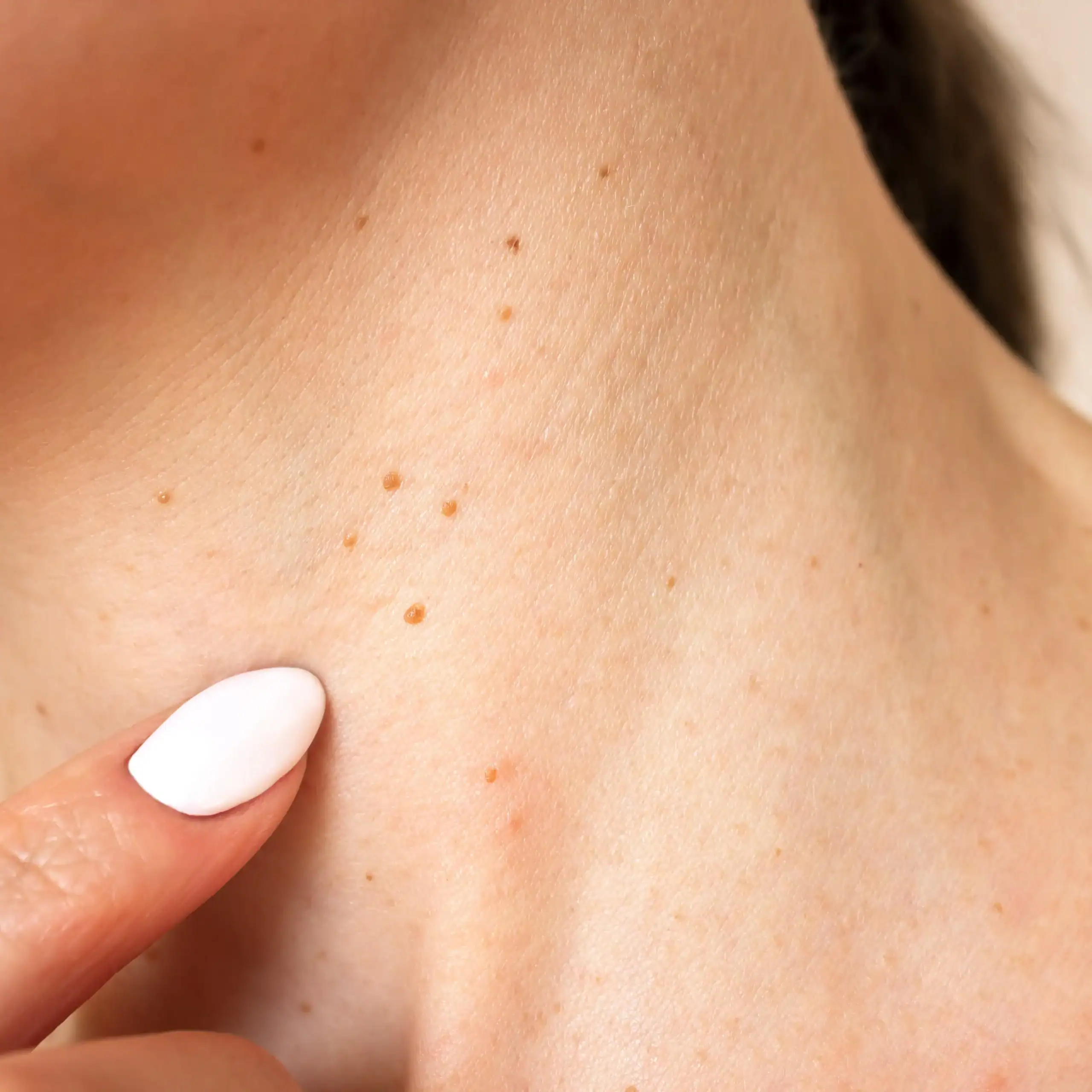 Skin growths and freckles on a woman's neck