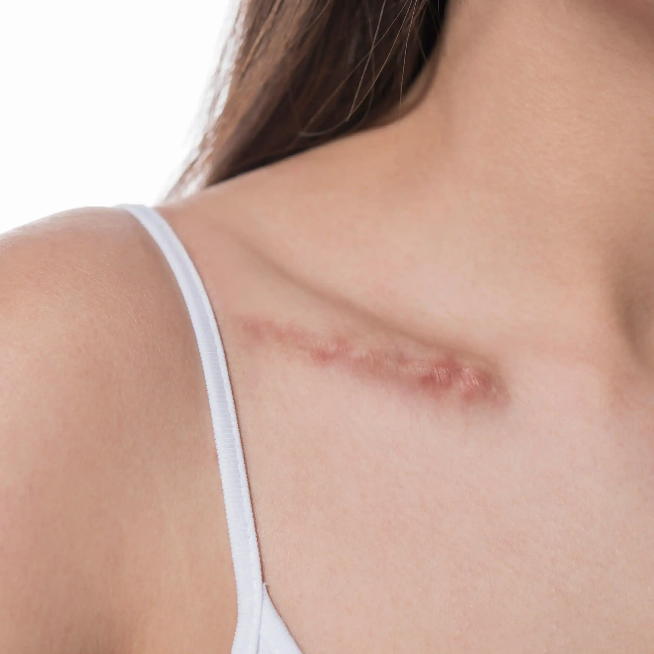 Woman with scar on her collarbone