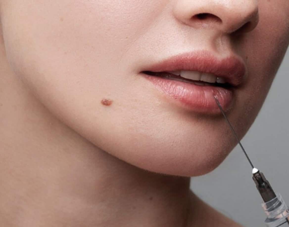 Woman about to get a lip injection