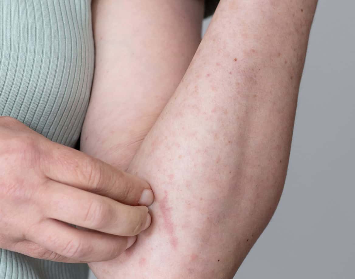 Woman scratches her arm