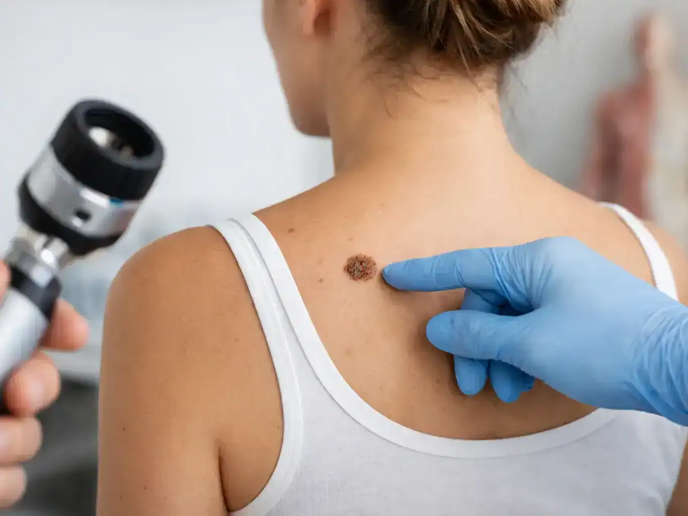 Mole Changes Warning Signs to Watch