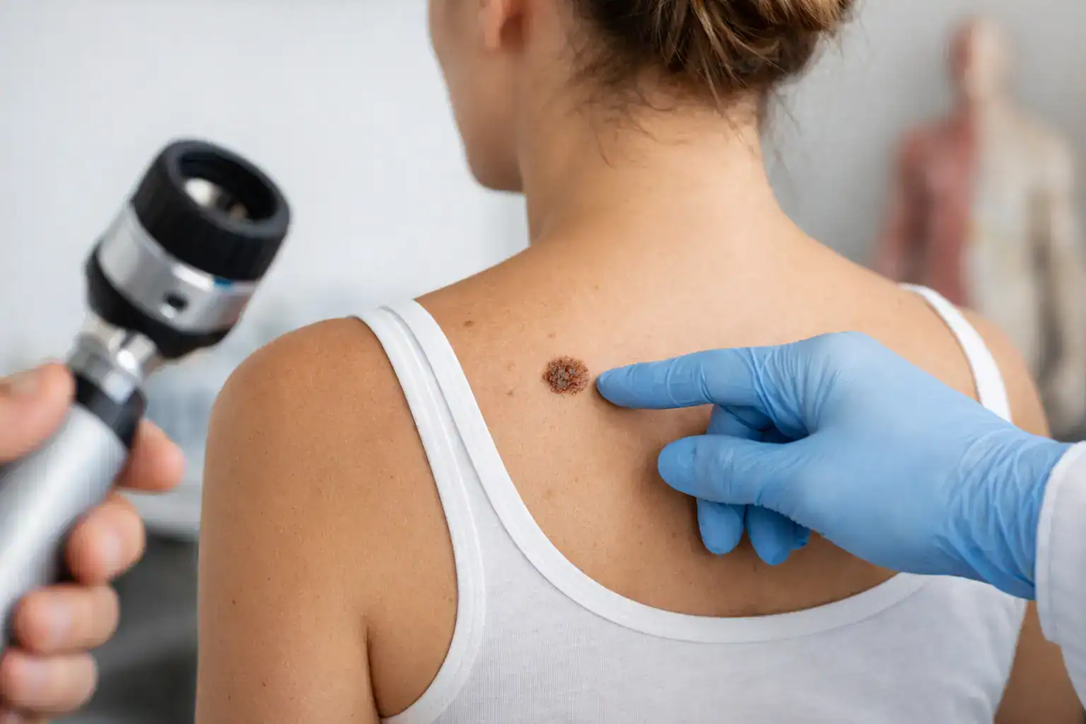 Mole Changes Warning Signs to Watch