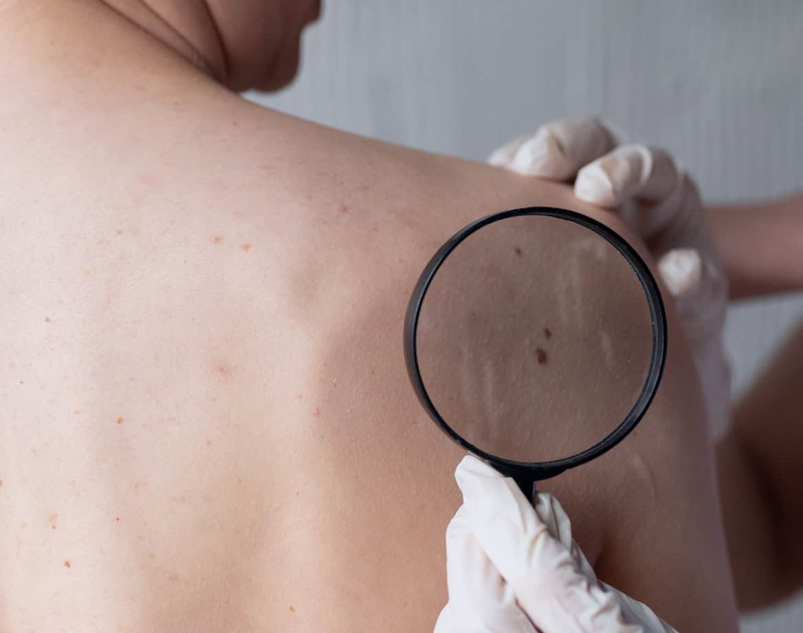 Man gets mole on his shoulder checked